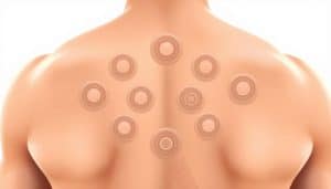 Cupping Therapy Marks Explanation